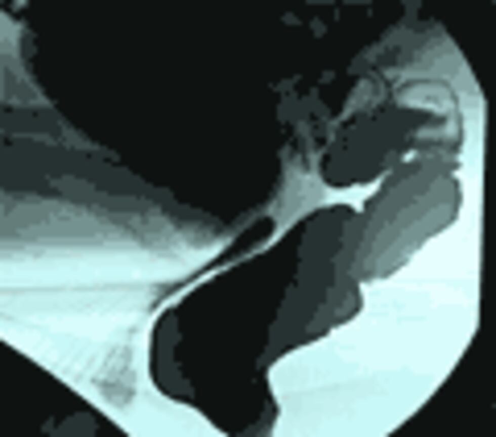 What is a Defecography?